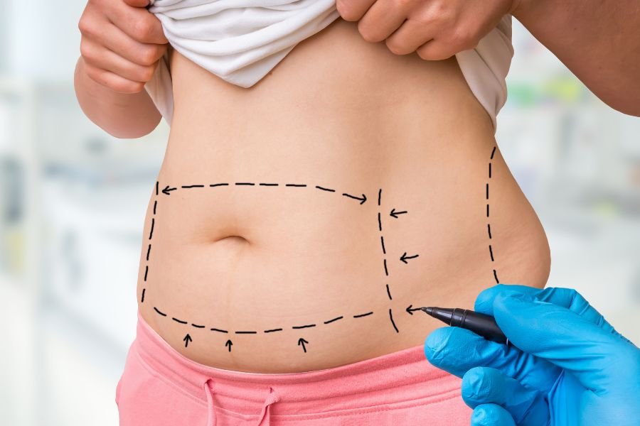 Alinhando expectativas: o que a cirurgia plástica pode e não pode fazer pelo seu corpo